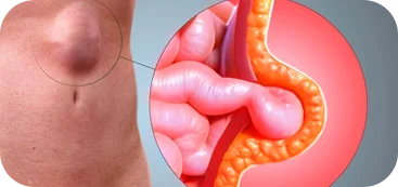 Hérnia tem cura sem cirurgia?